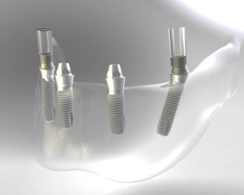 Bego_Abutments1.jpg