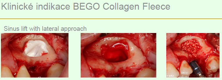 Bego Collagen Fleece Bego Collagen Fleece