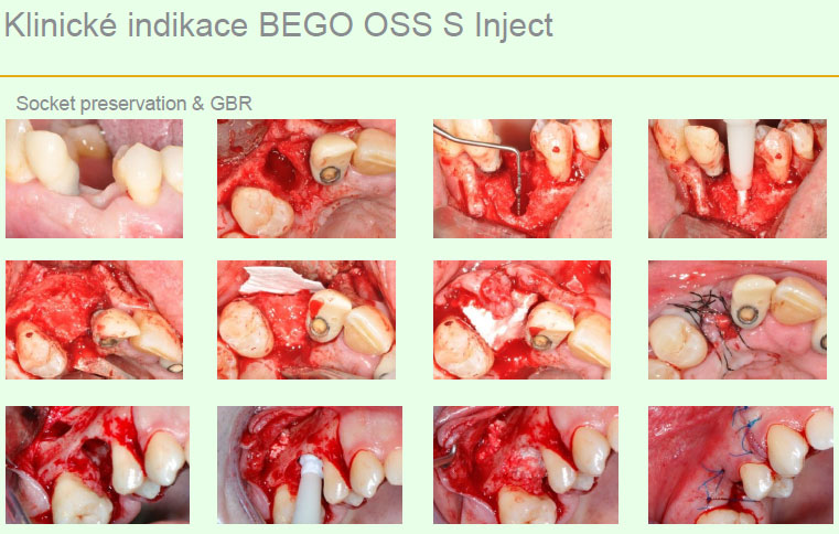 Bego Oss S Inject Bego Oss S Inject