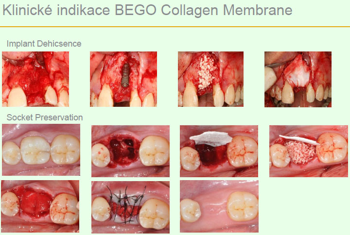 Bego Collagen Membrane Bego Collagen Membrane