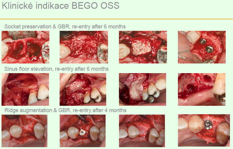 Bego Oss Bego Oss