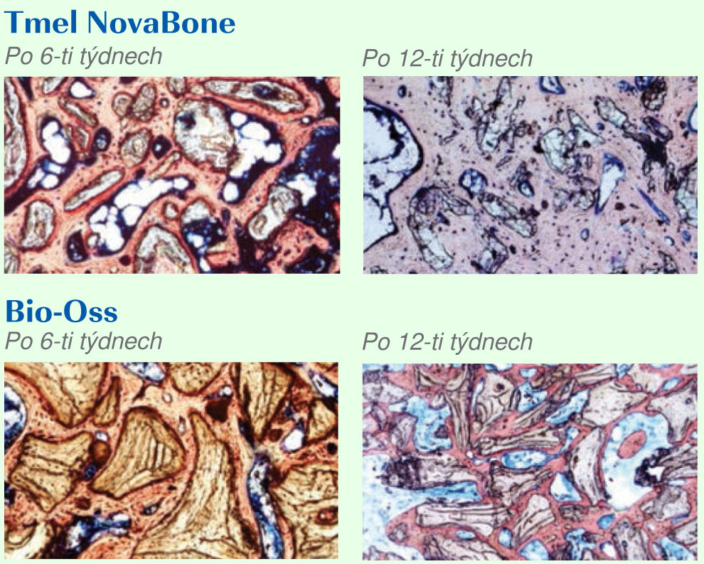 Novabone5 NovaBone5