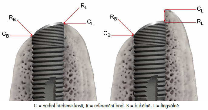 OsseoSpeedProfile_obr.13.jpg OsseoSpeedProfile_obr.13.jpg