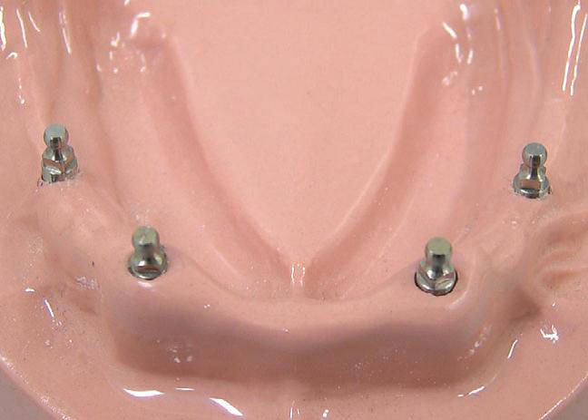 MS Implant2 MS Implant2