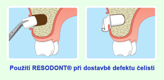 Resodont4.jpg Resodont4.jpg