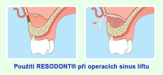 Resodont5.jpg Resodont5.jpg