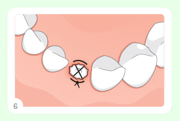 PARASORB Sombrero® 7 PARASORB Sombrero® 7