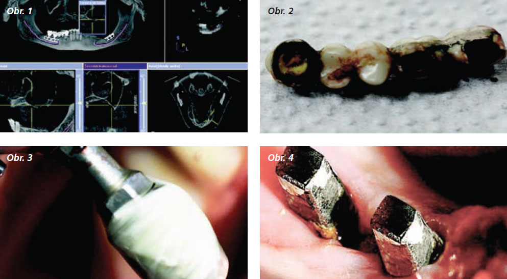 StomaTeam-5_2012_implantace_obr1_4.jpg StomaTeam-5_2012_implantace_obr1_4.jpg