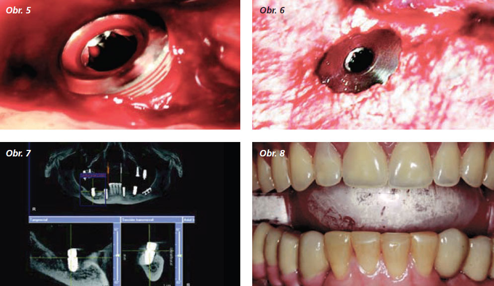 StomaTeam-5_2012_implantace_obr5_8.jpg StomaTeam-5_2012_implantace_obr5_8.jpg