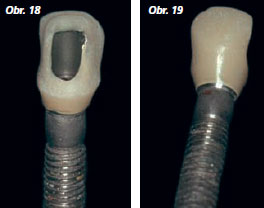 StomaTeam-6_2012_abutment_obr18_19.jpg StomaTeam-6_2012_abutment_obr18_19.jpg