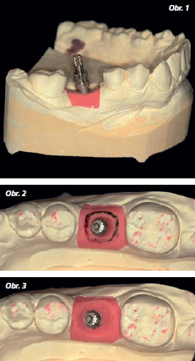 StomaTeam-6_2012_abutment_obr1_3.jpg