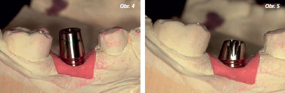 StomaTeam-6_2012_abutment_obr4_5.jpg StomaTeam-6_2012_abutment_obr4_5.jpg