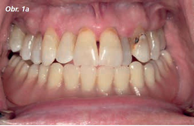 Osetreni_bezzube_abutment_5_13_1 Osetreni_bezzube_abutment_5_13_1