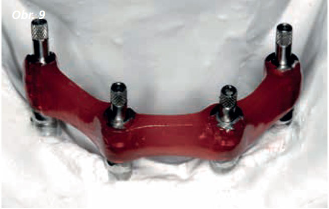 Osetreni_bezzube_abutment_5_13_8 Osetreni_bezzube_abutment_5_13_8
