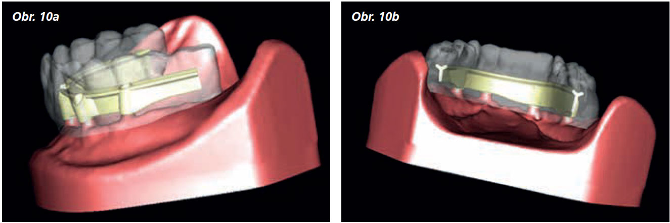 Osetreni_bezzube_abutment_5_13_9 Osetreni_bezzube_abutment_5_13_9