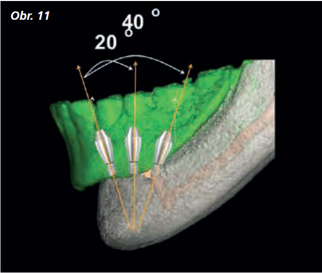 Osetreni_bezzube_abutment_5_13_10 Osetreni_bezzube_abutment_5_13_10