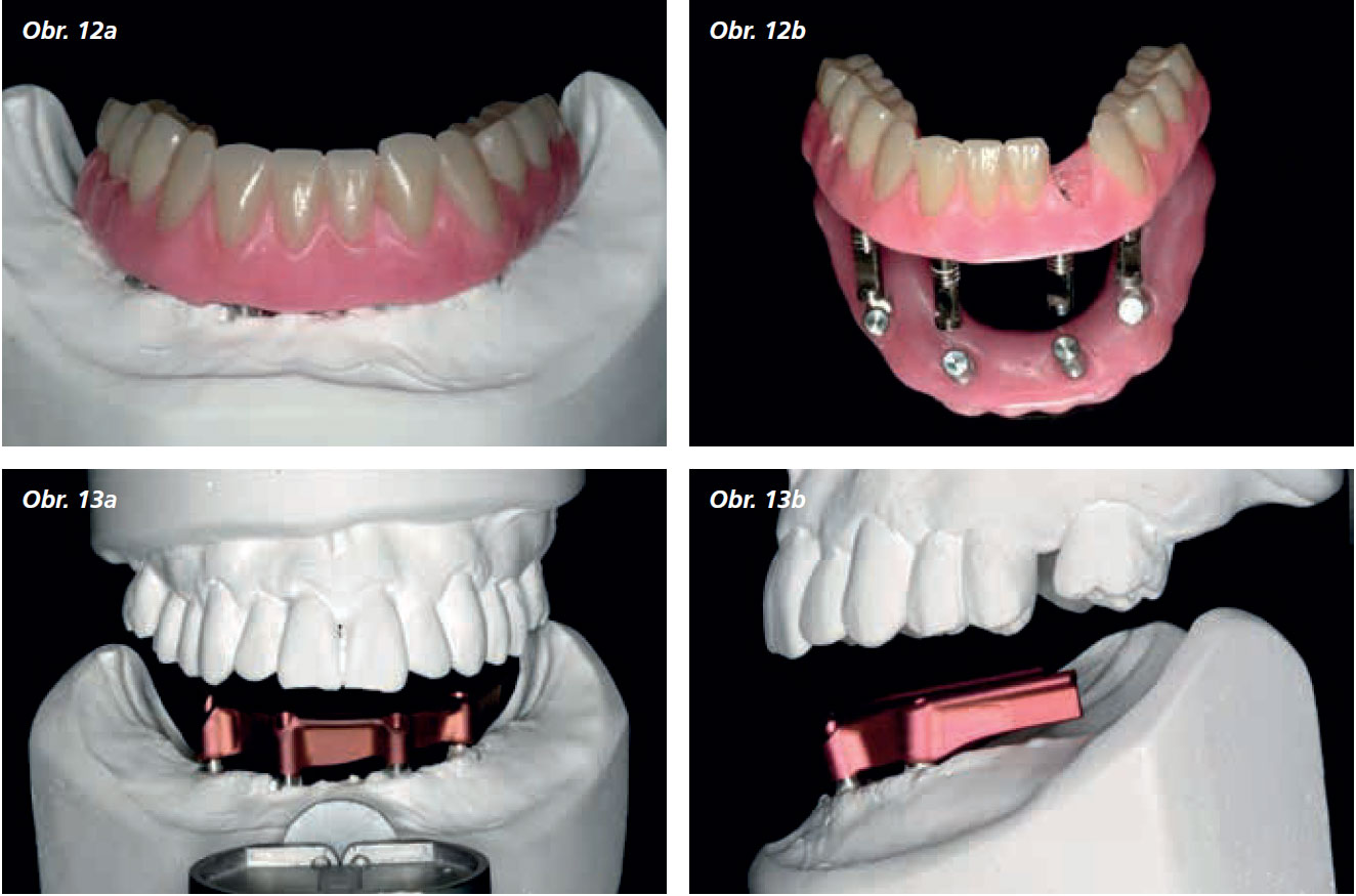 Osetreni_bezzube_abutment_5_13_11 Osetreni_bezzube_abutment_5_13_11