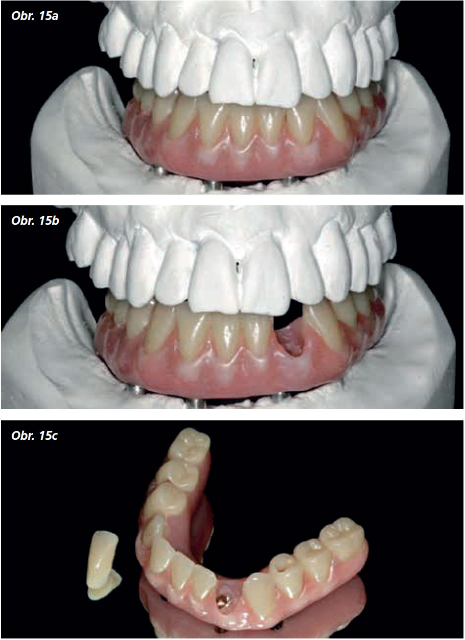 Osetreni_bezzube_abutment_5_13_13 Osetreni_bezzube_abutment_5_13_13