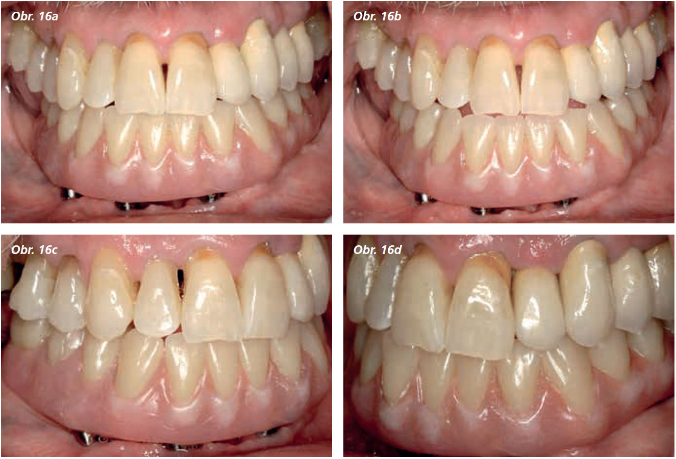 Osetreni_bezzube_abutment_5_13_14 Osetreni_bezzube_abutment_5_13_14
