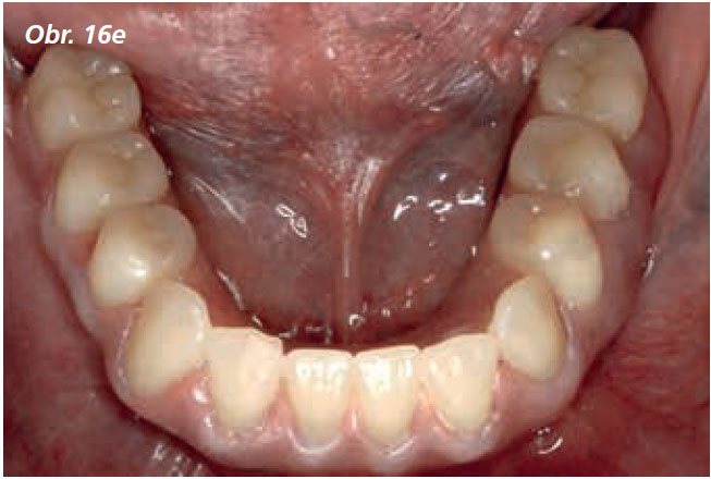 Osetreni_bezzube_abutment_5_13_15 Osetreni_bezzube_abutment_5_13_15