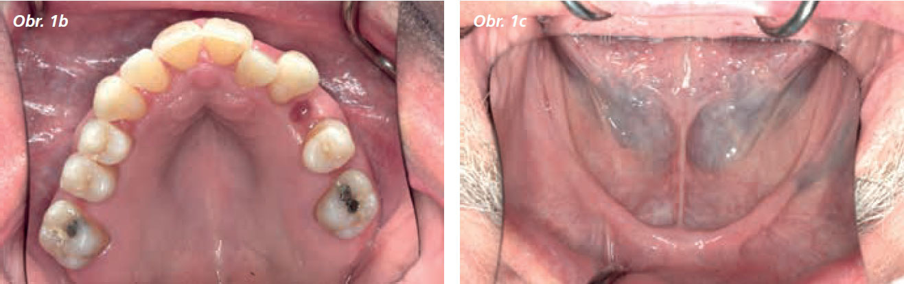 Osetreni_bezzube_abutment_5_13_2 Osetreni_bezzube_abutment_5_13_2