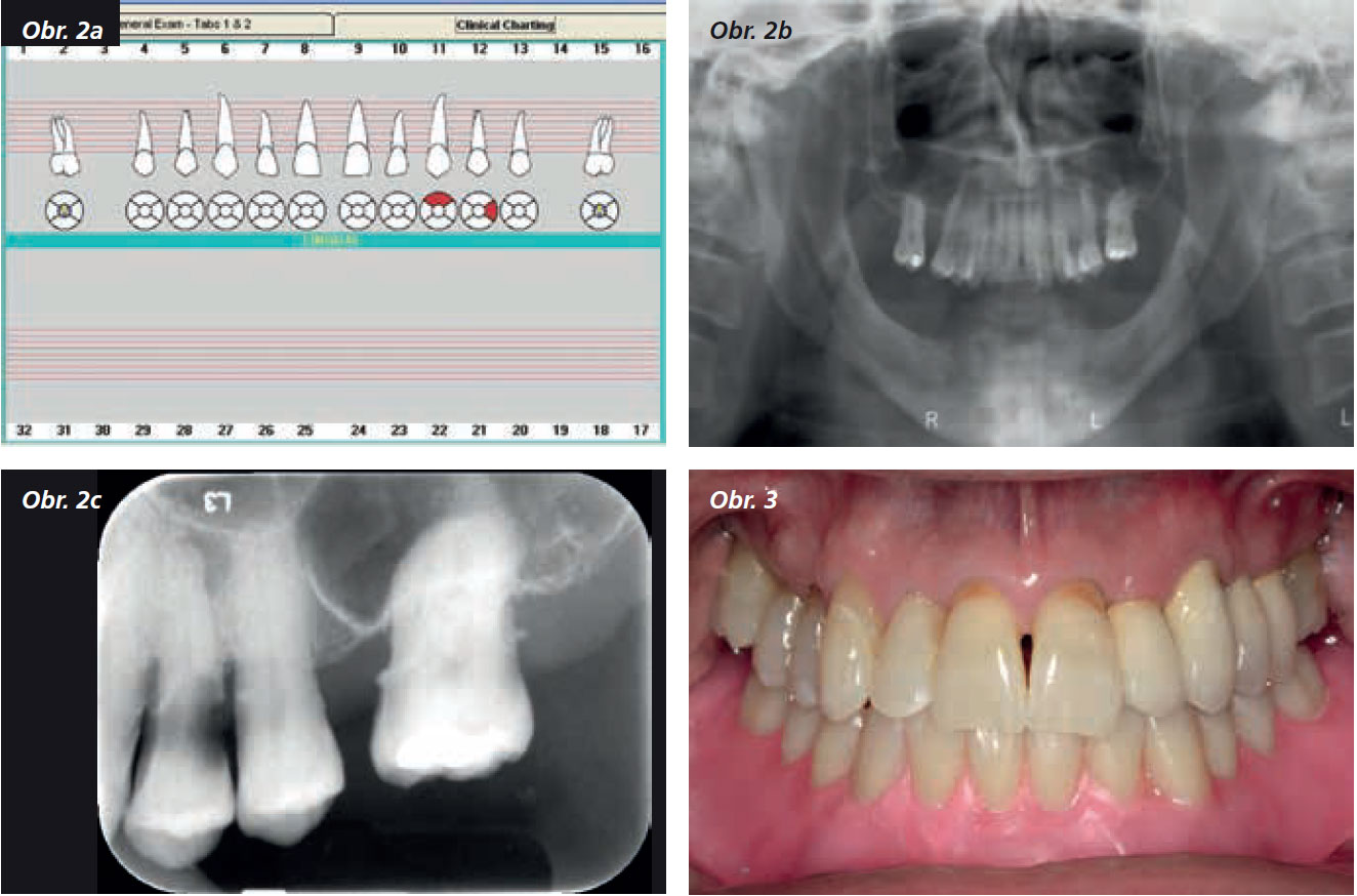 Osetreni_bezzube_abutment_5_13_3 Osetreni_bezzube_abutment_5_13_3