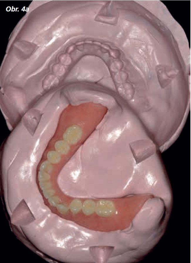 Osetreni_bezzube_abutment_5_13_4 Osetreni_bezzube_abutment_5_13_4