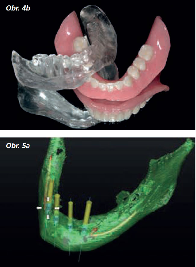 Osetreni_bezzube_abutment_5_13_5 Osetreni_bezzube_abutment_5_13_5
