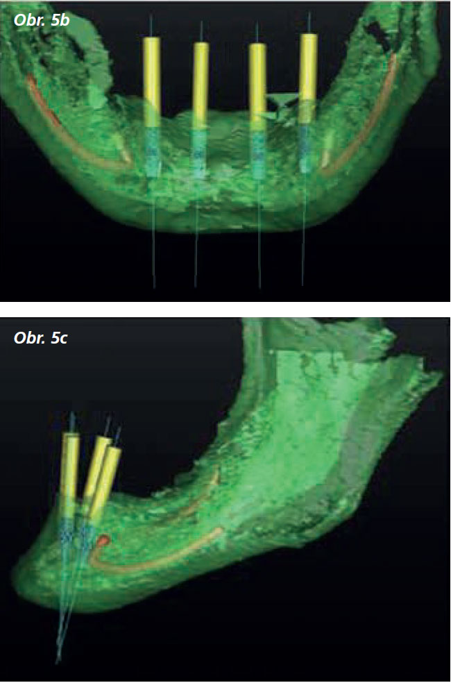 Osetreni_bezzube_abutment_5_13_6 Osetreni_bezzube_abutment_5_13_6