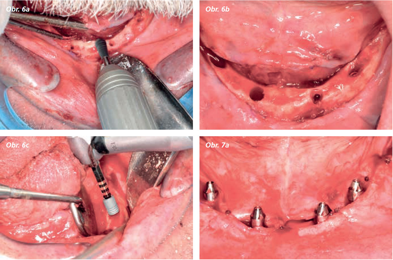 Osetreni_bezzube_abutment_5_13_7 Osetreni_bezzube_abutment_5_13_7