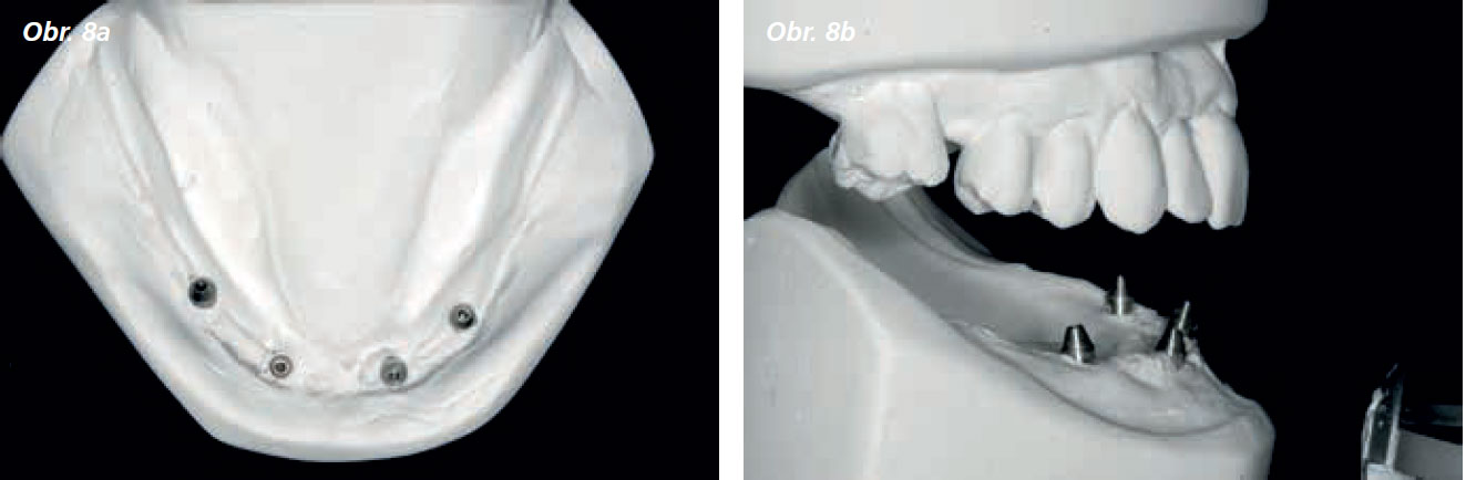 Osetreni_bezzube_abutment_5_13_7 Osetreni_bezzube_abutment_5_13_7