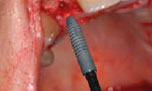 implants_Astra4.jpg implants_Astra4.jpg
