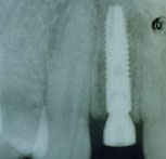 implants_Astra5.jpg implants_Astra5.jpg