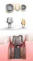 implants_Astra7