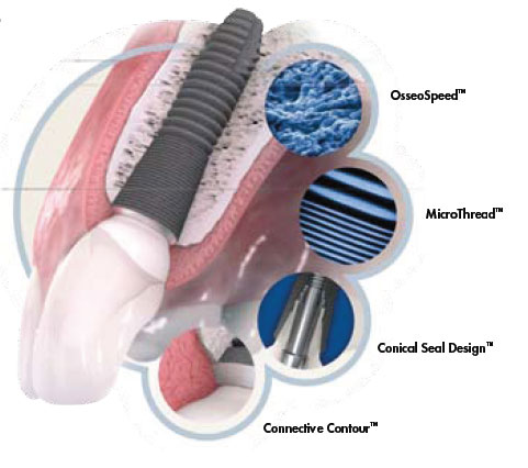 implants_Astra9.jpg