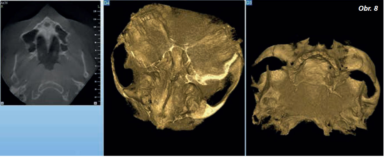 Lateral_sinus_5_13_4 Lateral_sinus_5_13_4