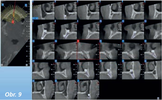Lateral_sinus_5_13_5 Lateral_sinus_5_13_5