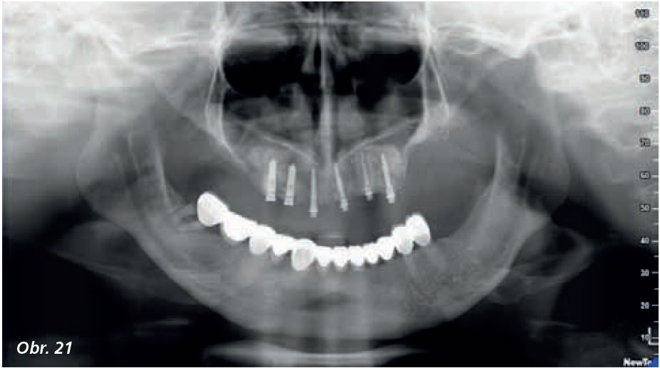 Lateral_sinus_5_13_14 Lateral_sinus_5_13_14