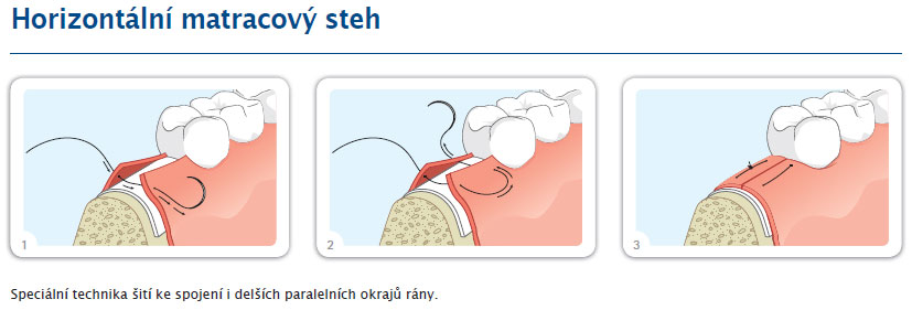 Horizontální matracový steh Horizontální matracový steh