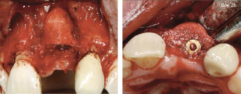 SonicWeld Alveolar protector SonicWeld Alveolar protector